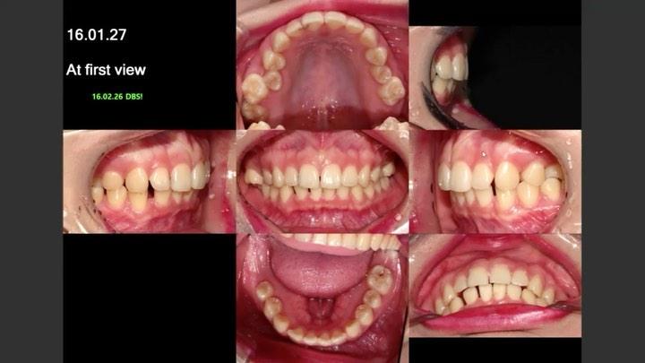 treatment of kissing molar and several molar impac…