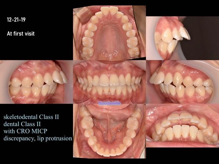 Treatment of skeletal Class II
dental Class I with…