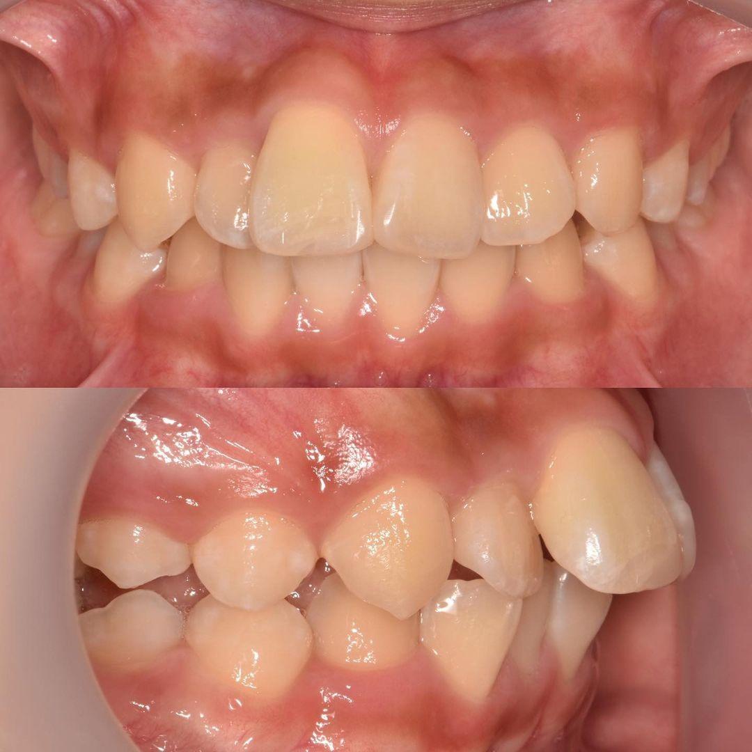 Treatment in progress very challenging case which …