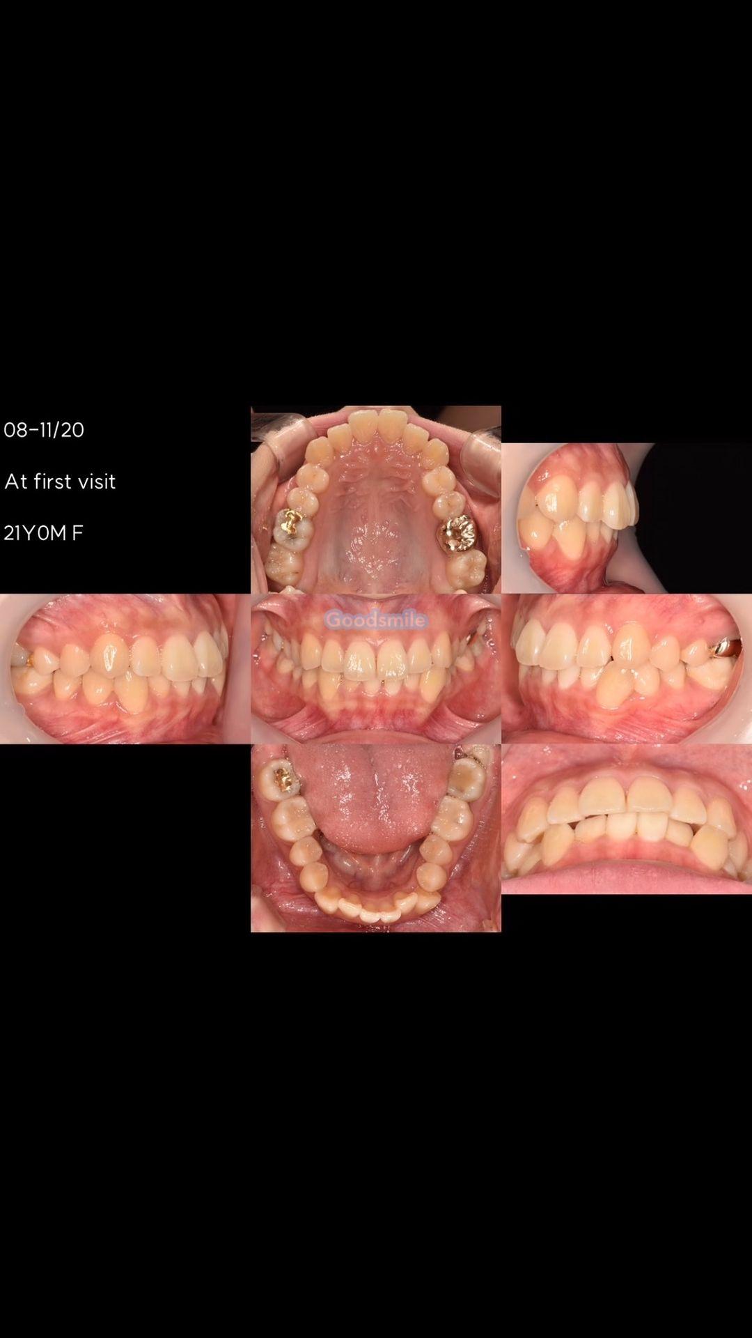 Treatment of skeletal Class III, dental Class I wi…