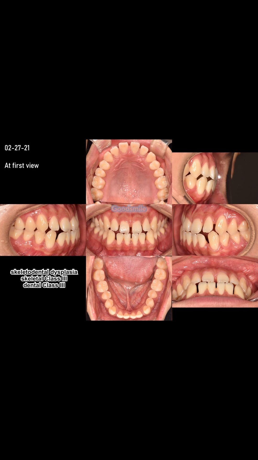 Camouflage treatment of skeletal Class III, dental…